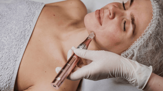 Microneedlingbehandling i ansiktet med dermapen utförd av hudterapeut, närbild som illustrerar om microneedling gör ont och hur behandlingen upplevs på huden