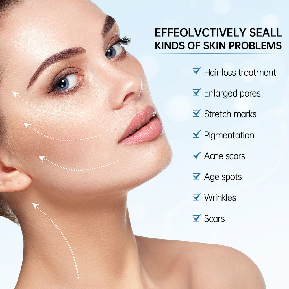 Femme montrant les résultats de microneedling pour le traitement des problèmes de peau tels que les pores dilatés, les cicatrices, les cicatrices d'acné, les taches pigmentaires, les rides et les ridules.